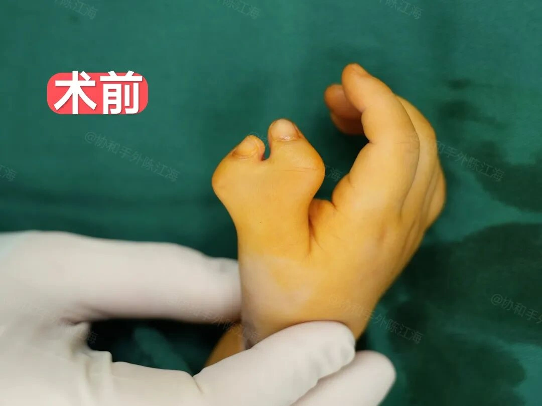 1个案例让爸妈认清现实，及时切掉多指术后看不出来了