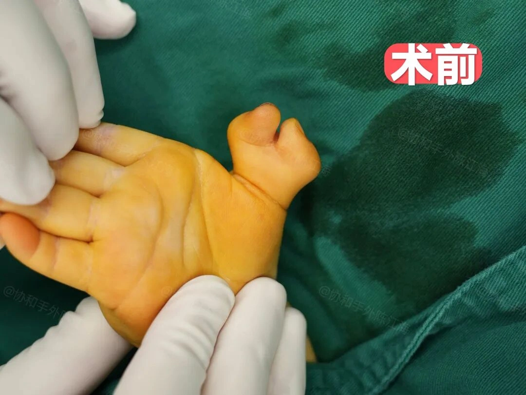 1个案例让爸妈认清现实,及时切掉多指术后看不出来了