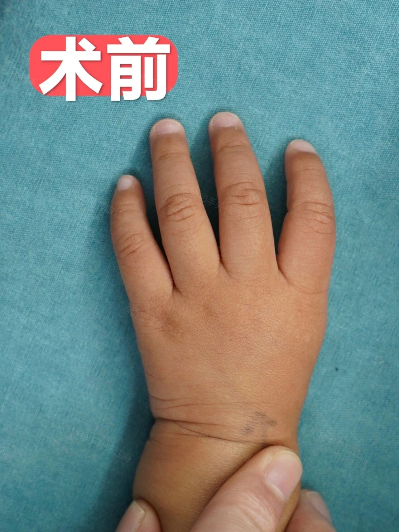 产检正常，宝宝却是4指，术后569天是什么样