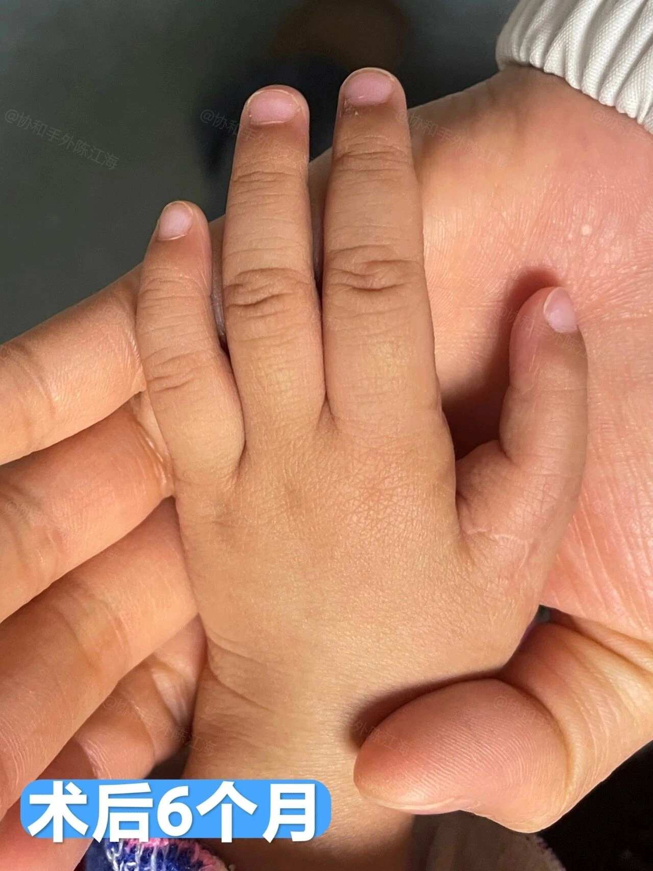 产检正常，宝宝却是4指，术后569天是什么样