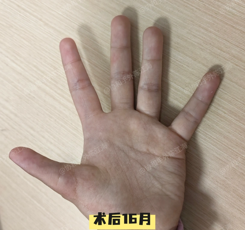 双手有12根手指,但双手却都没有大拇指!
