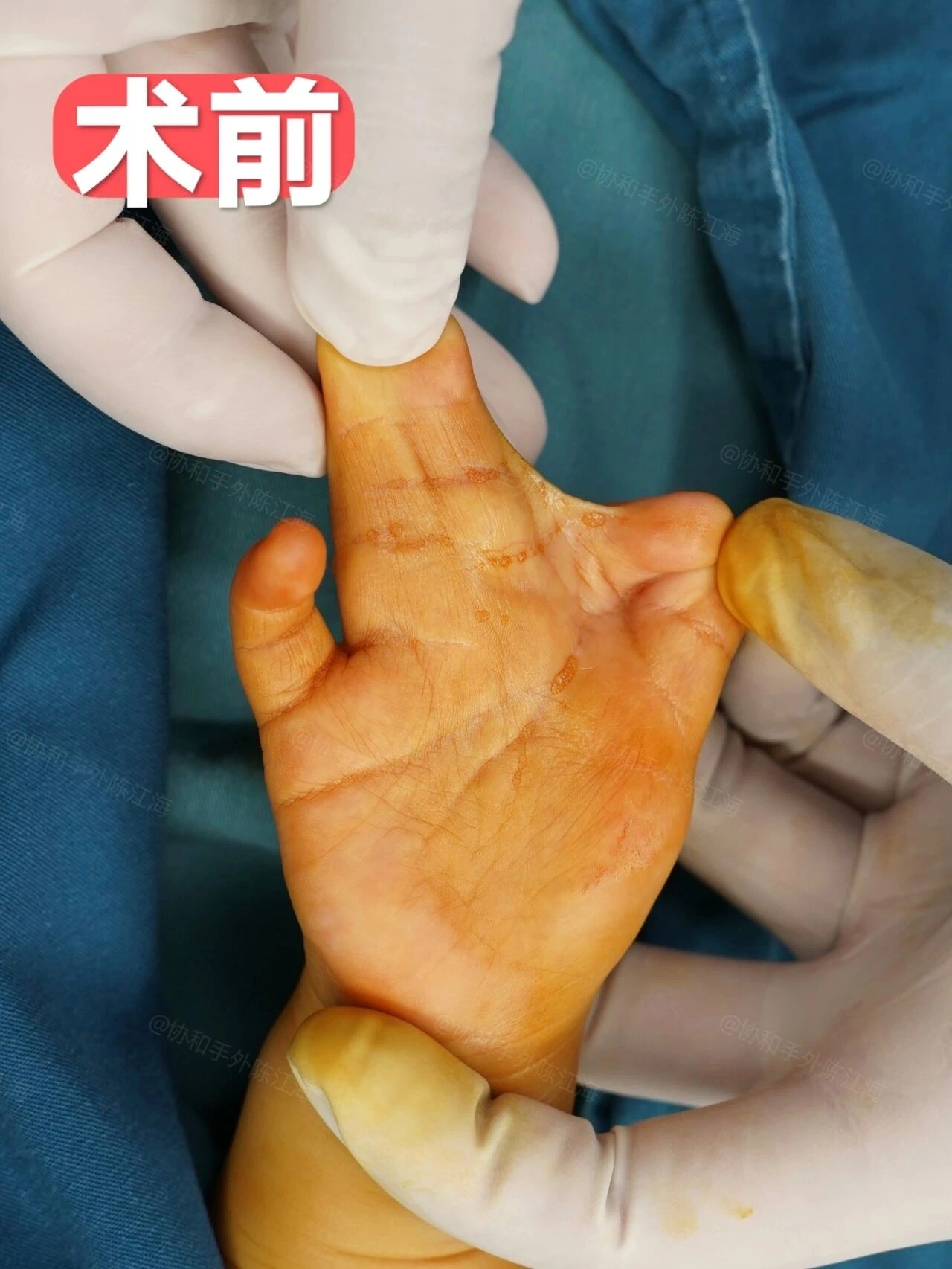 “佛手”小姑娘并指术后1年7个月的变化