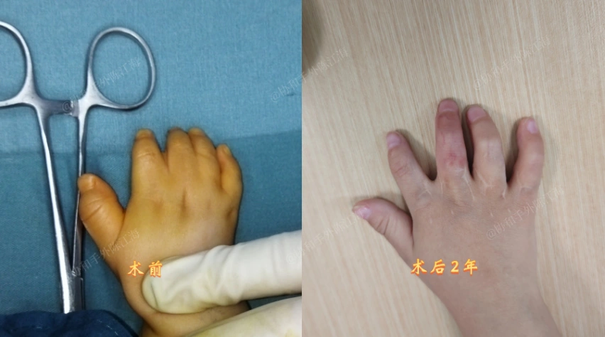 并指免植皮 | 案例42《1次手术+2年锻炼，宝宝小手好用疤痕也浅》