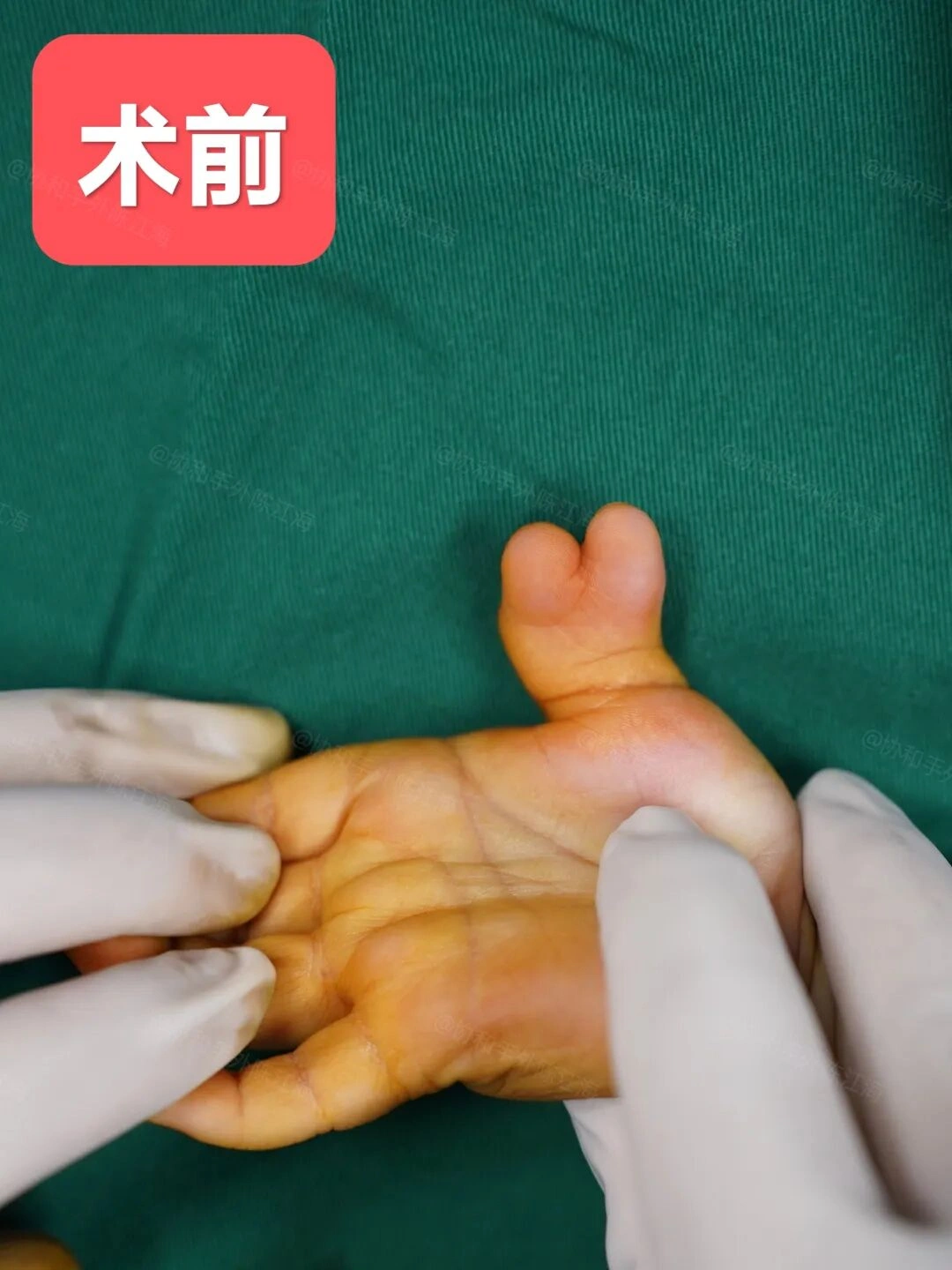 《多指案例84丨术前小多指侧偏严重,术后7个月支具绑直了》