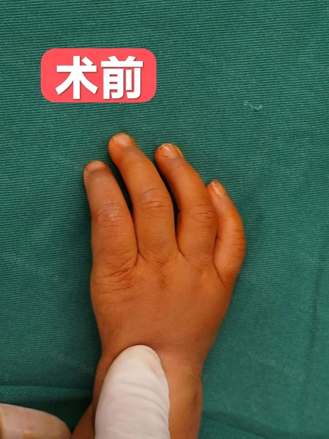 宝宝出生没有大拇指，抓握都是问题，示指拇化&ldquo;变出&rdquo;新拇指