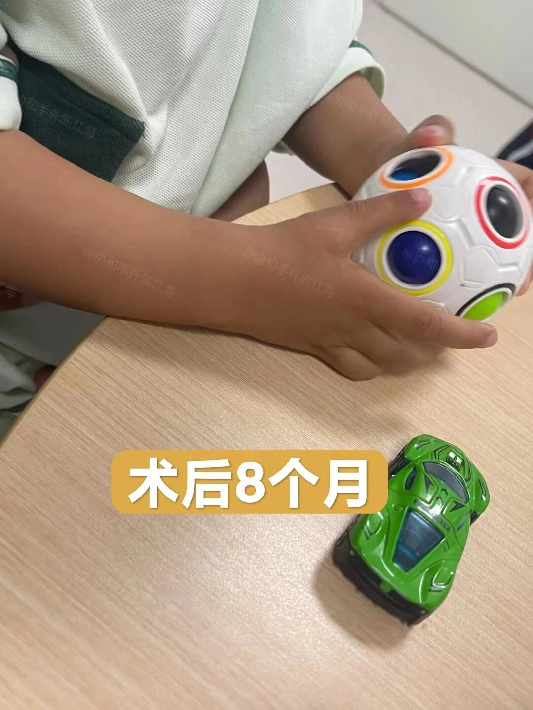 宝宝出生没有大拇指,抓握都是问题,示指拇化“变出”新拇指
