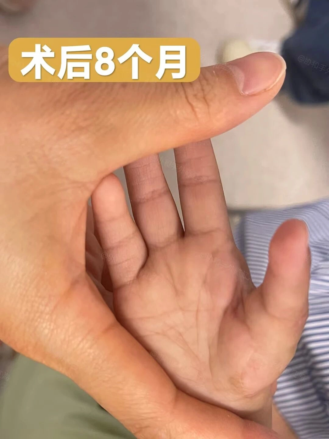 宝宝出生没有大拇指,抓握都是问题,示指拇化“变出”新拇指