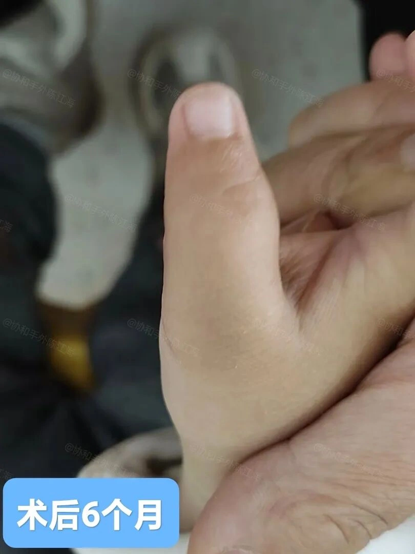 《多指案例84丨术前小多指侧偏严重,术后7个月支具绑直了》