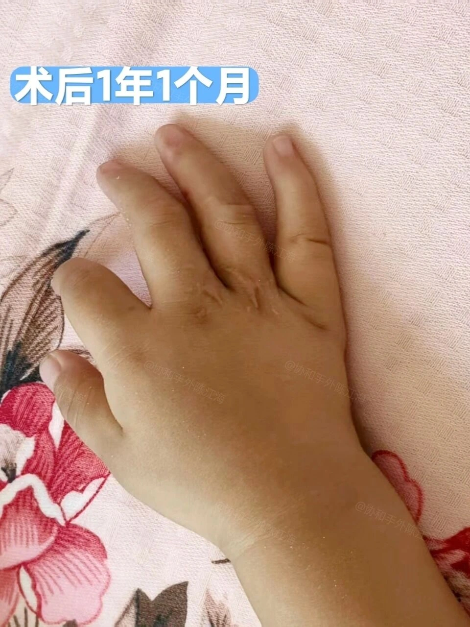 小宝“乱七八糟”的双手,还能“修好”吗?