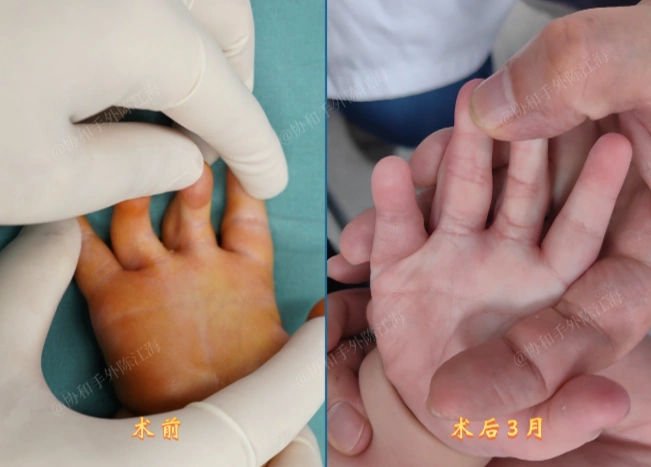 孩子出生后,双手中指和无名指一直无法完全伸直