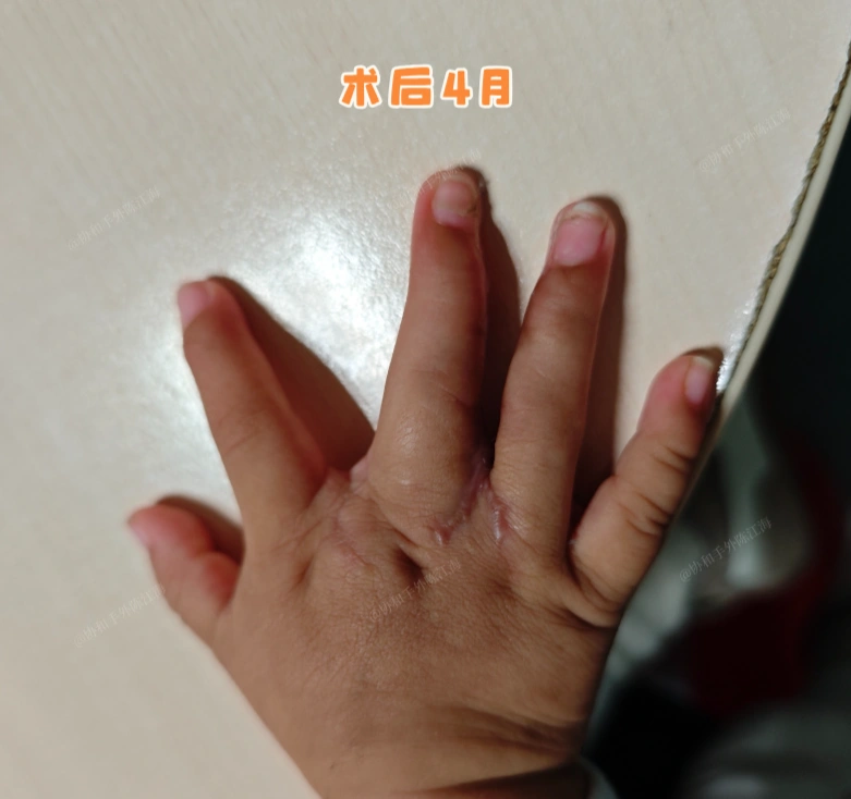 一次手术解决手上3个问题，术后10个月小手是这样的