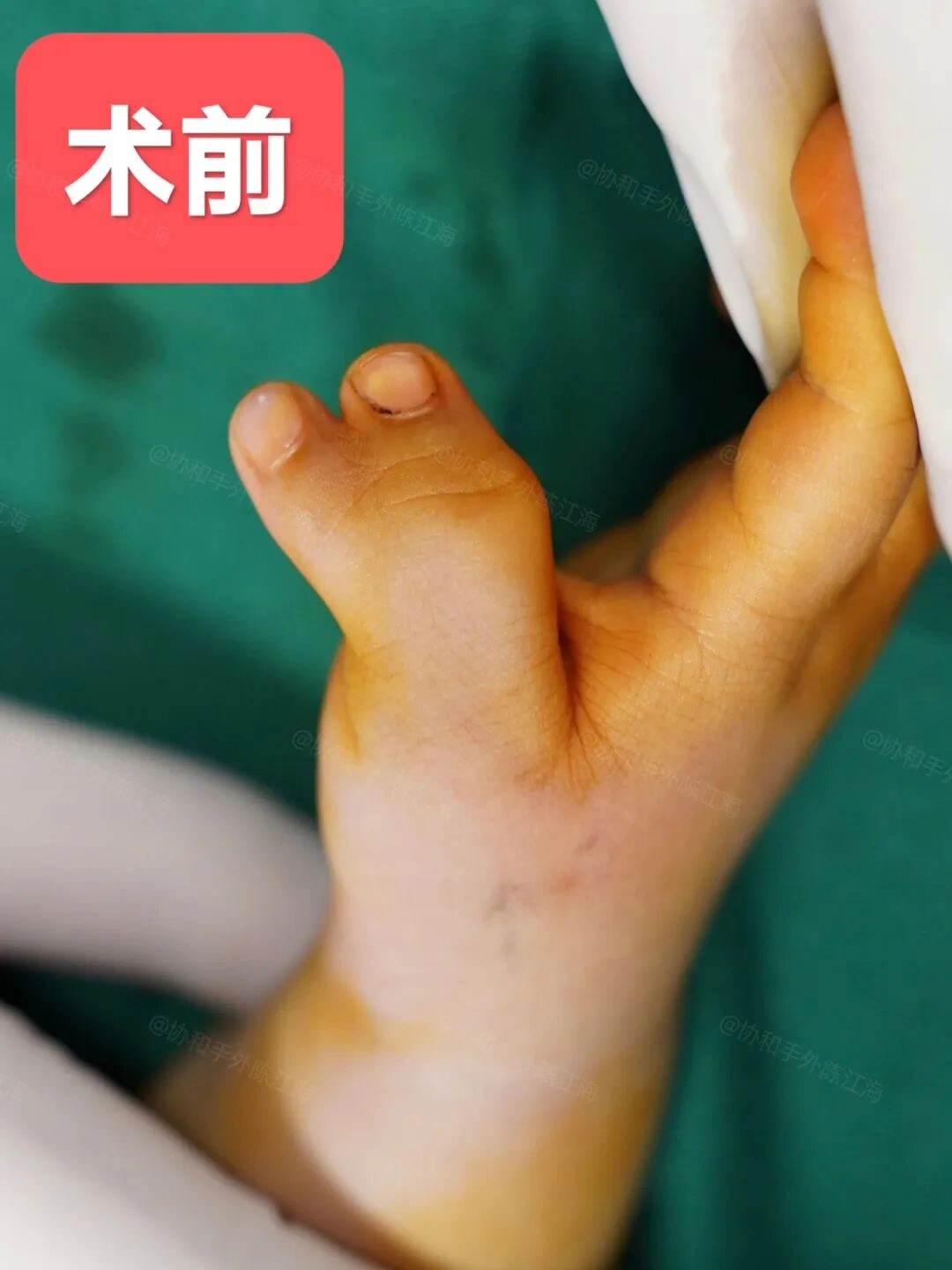 《多指案例84丨术前小多指侧偏严重，术后7个月支具绑直了》