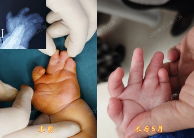 这是一个双手多并指,双脚多趾的孩子