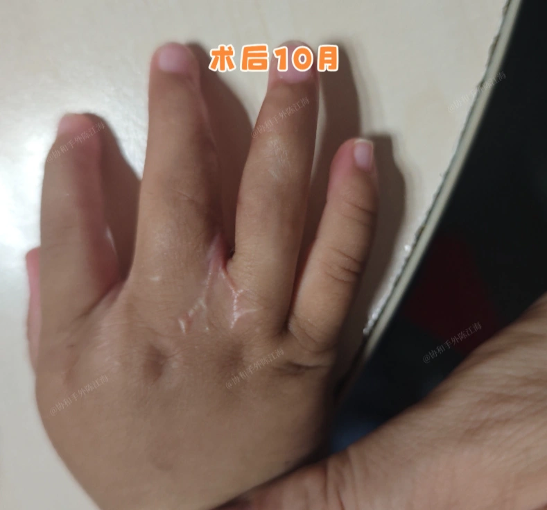 一次手术解决手上3个问题，术后10个月小手是这样的