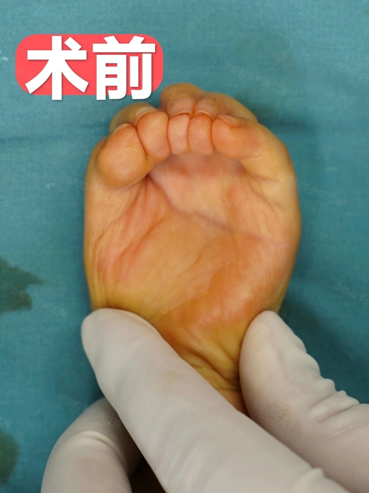 “佛手”小姑娘并指术后1年7个月的变化