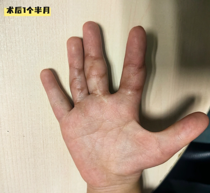 刚出生的时候,妈妈就发现孩子手指伸不直