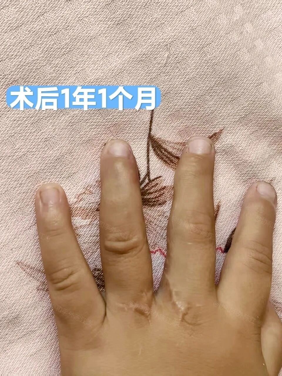 小宝“乱七八糟”的双手,还能“修好”吗?