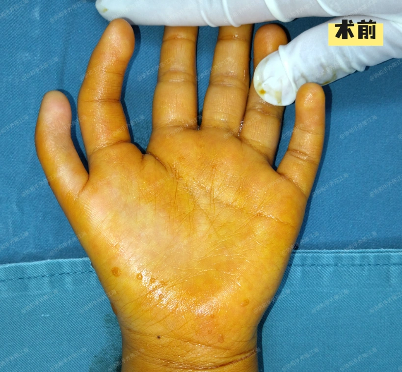 这是一个有6根手指，但却缺大拇指的孩子
