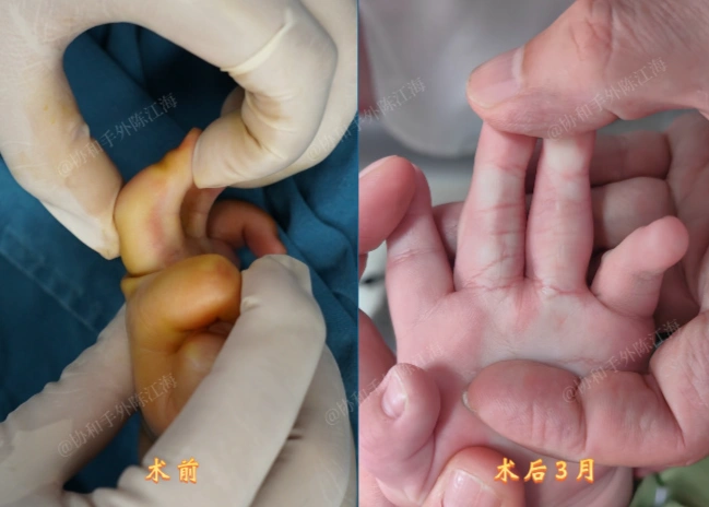 孩子出生后,双手中指和无名指一直无法完全伸直