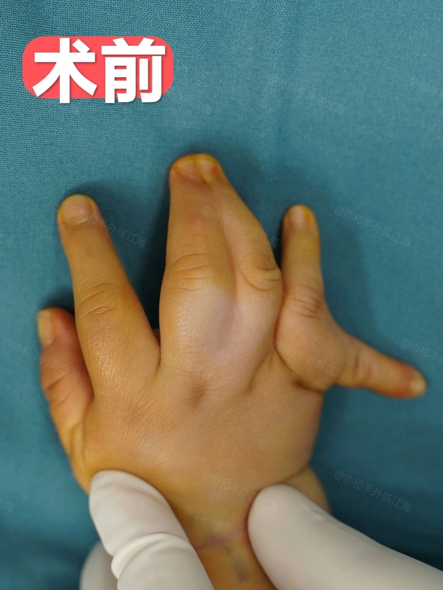 小宝“乱七八糟”的双手,还能“修好”吗?
