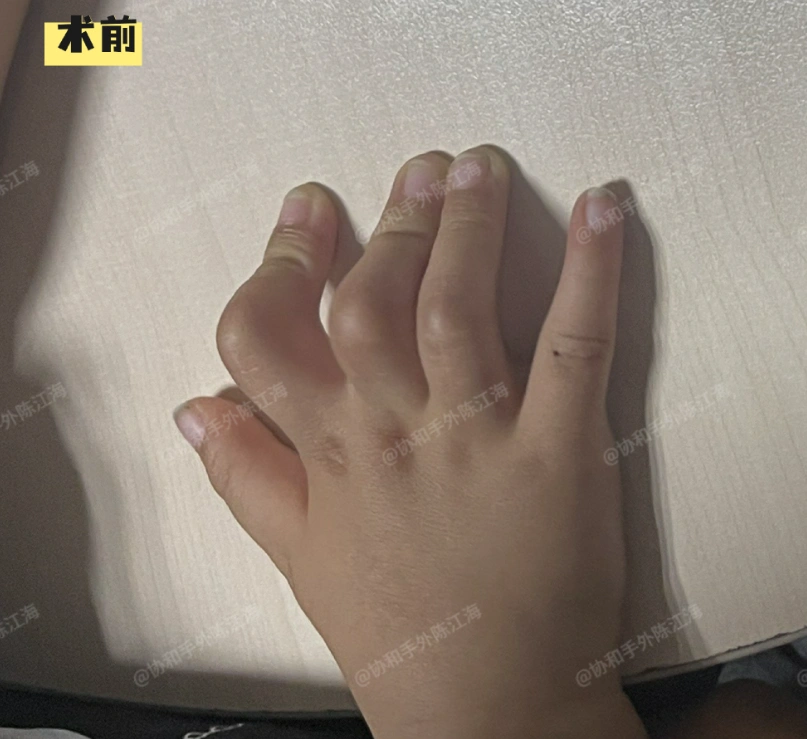 刚出生的时候，妈妈就发现孩子手指伸不直