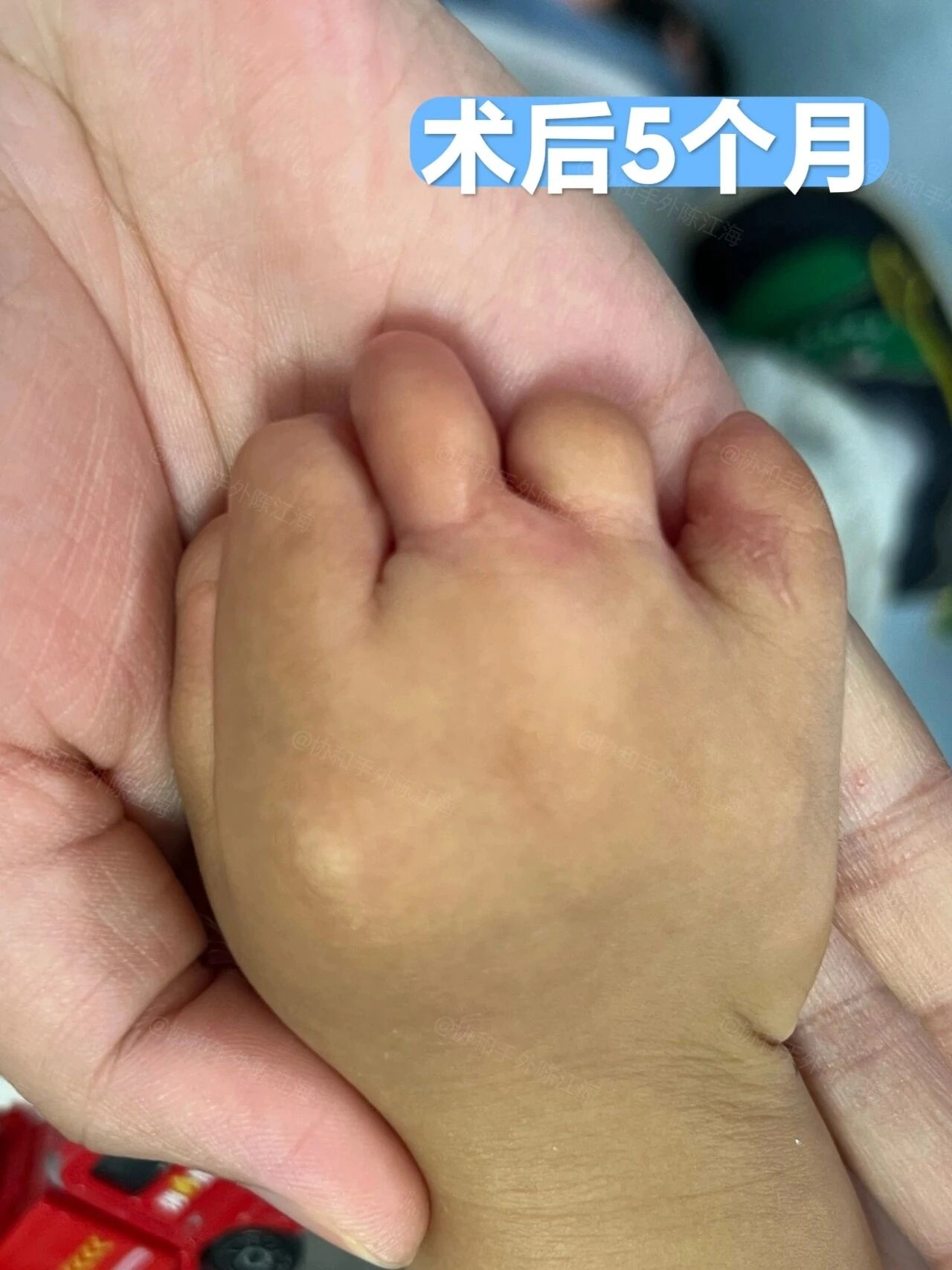 出生没有5指，还能无中生有吗？