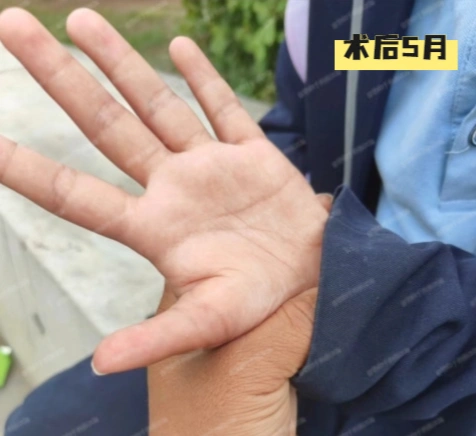 这是一个有6根手指,但却缺大拇指的孩子