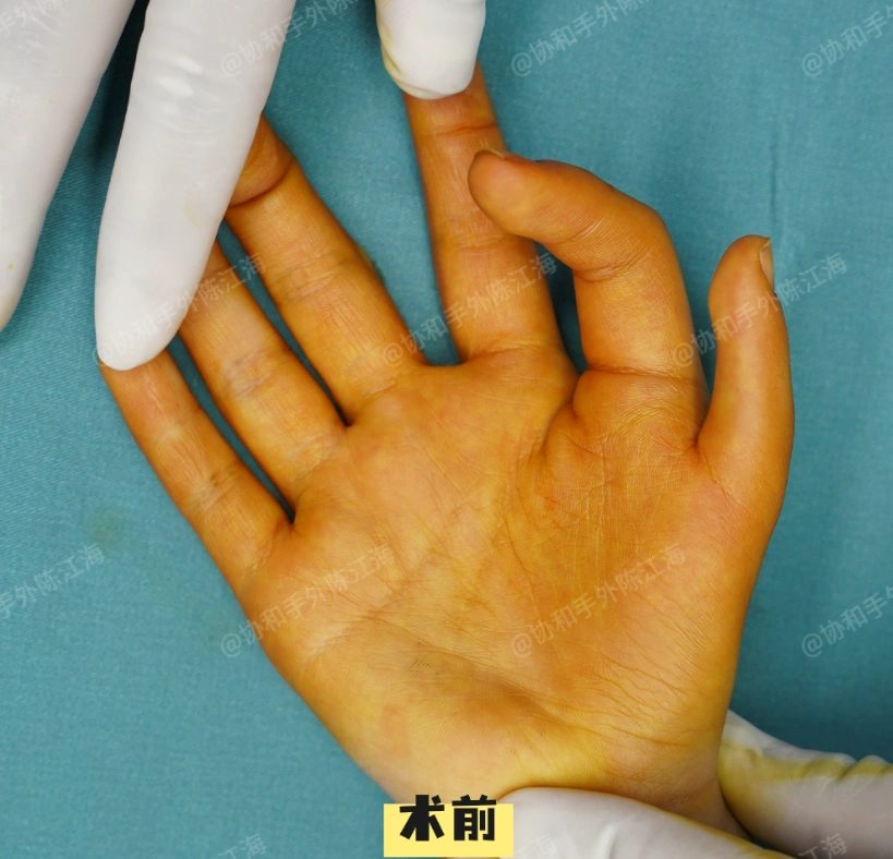 双手有12根手指,但双手却都没有大拇指!