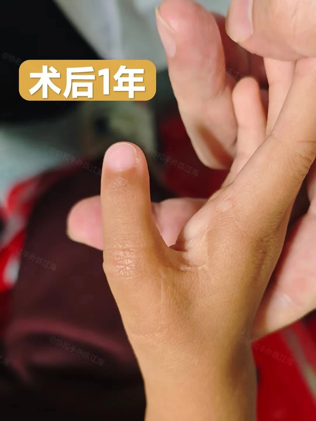 宝宝出生没有大拇指,抓握都是问题,示指拇化“变出”新拇指
