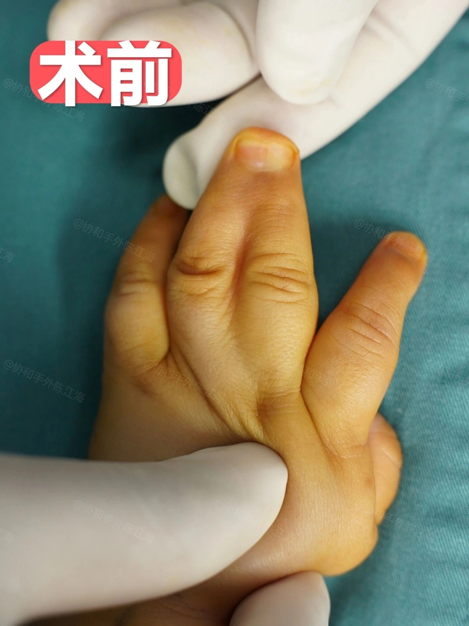 小宝“乱七八糟”的双手,还能“修好”吗?