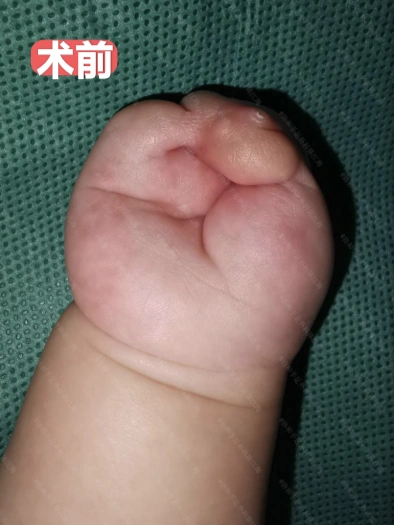 出生没有5指，还能无中生有吗？