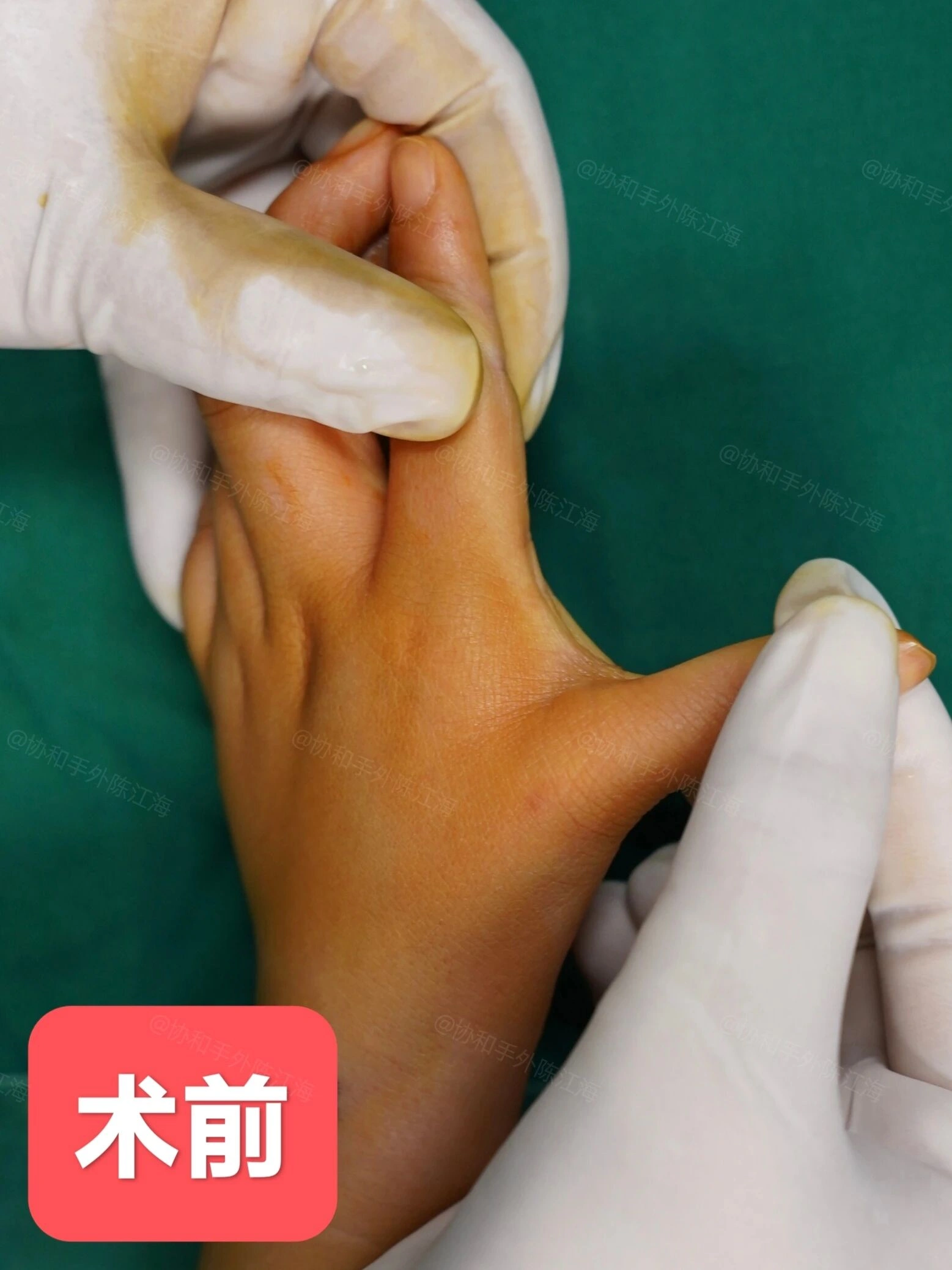 孩子拇指活动不好需警惕