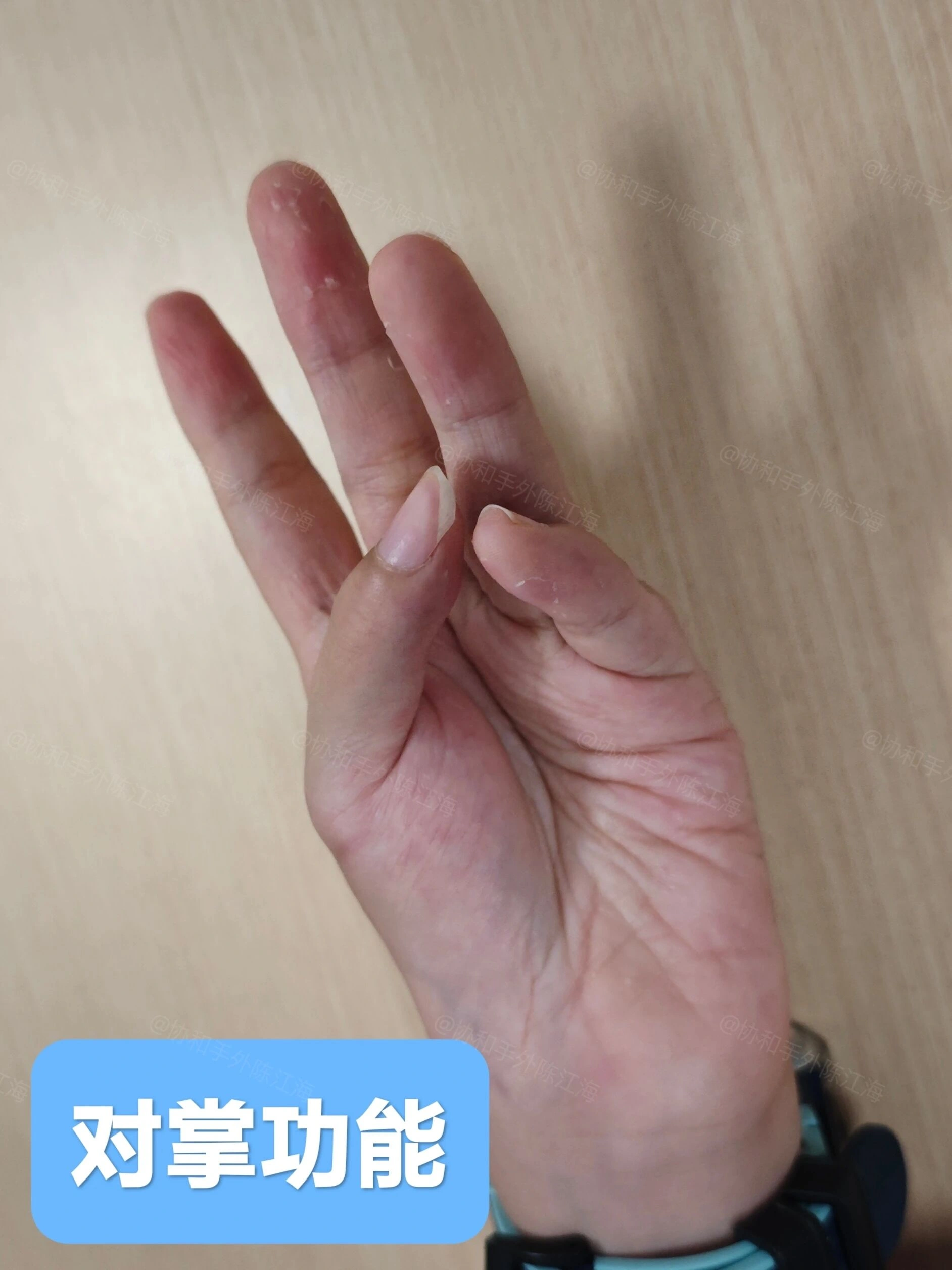 孩子拇指活动不好需警惕