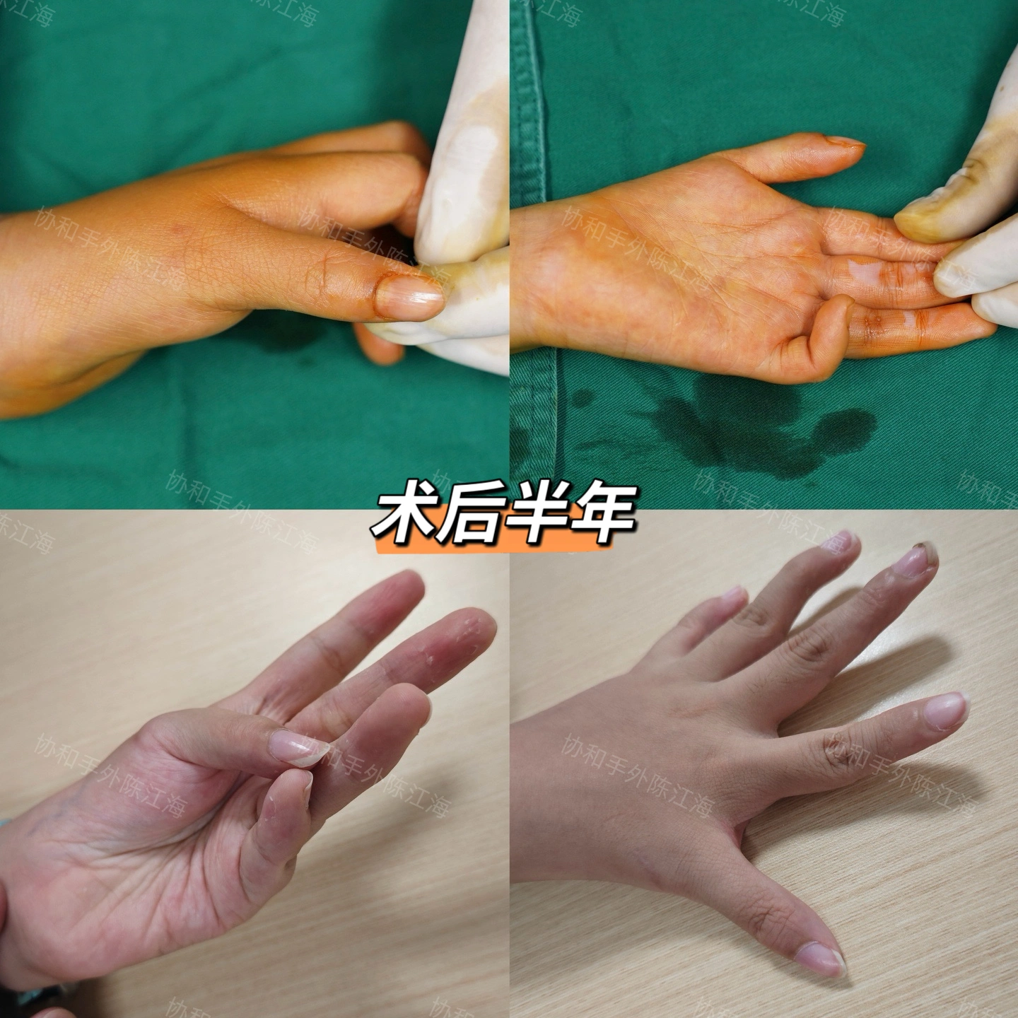 孩子拇指活动不好需警惕