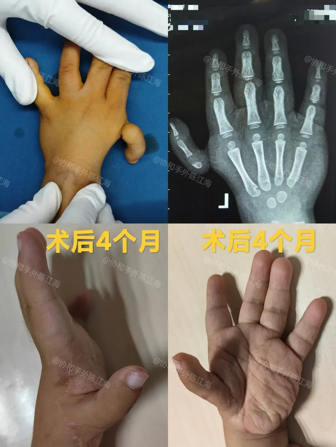 漂浮拇对孩子的影响、治疗以及术后护理与锻炼