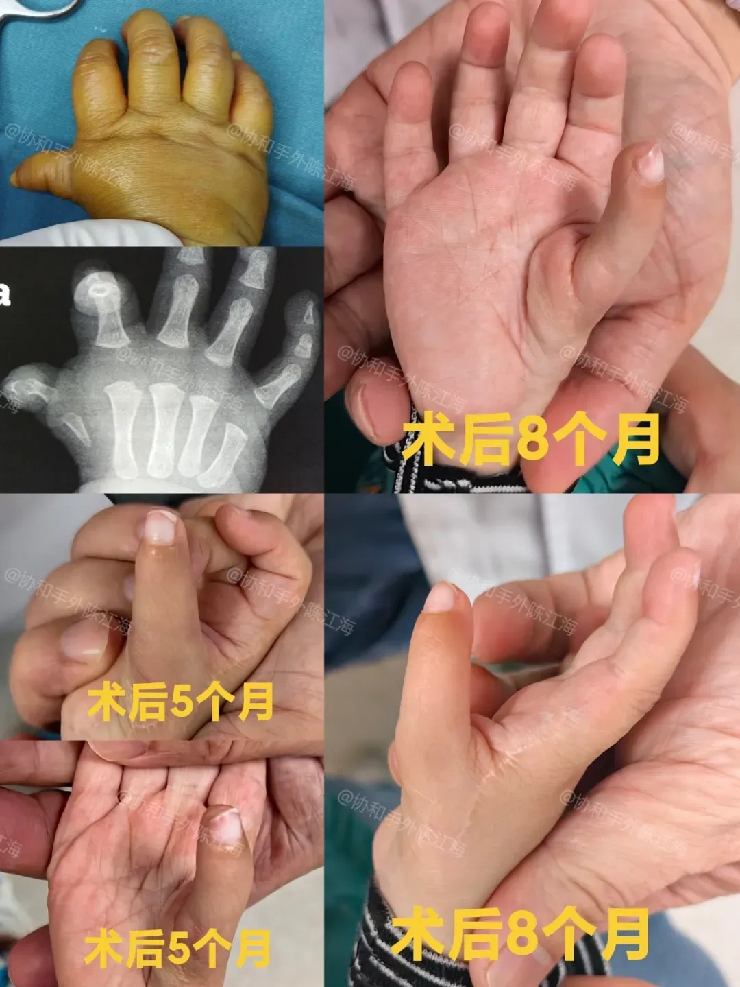 漂浮拇对孩子的影响、治疗以及术后护理与锻炼