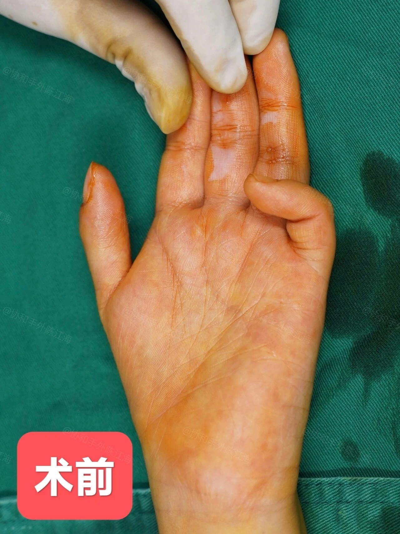 孩子拇指活动不好需警惕